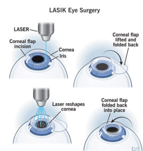 21805-lasik-eye-surgery